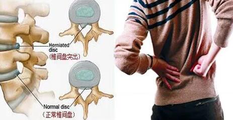 腰椎间盘突出压迫神经腿疼怎么治 腰椎间盘突出能自愈吗 