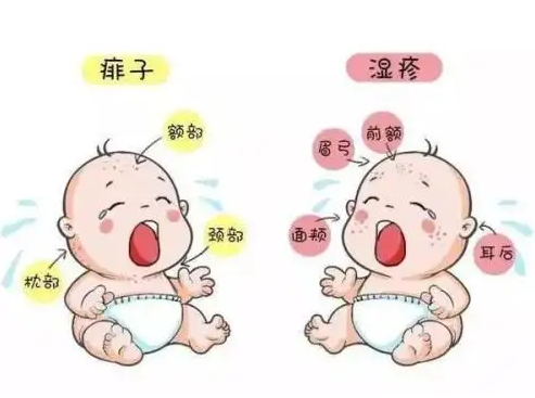  婴儿湿疹怎么处理是最好办法 通过中医治疗的效果如何呢