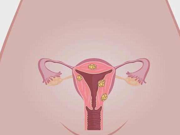 女性为什么会得宫颈癌 中医如何预防宫颈癌呢