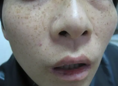 脸上雀斑影响心情 脸上雀斑怎么才能淡化内调？